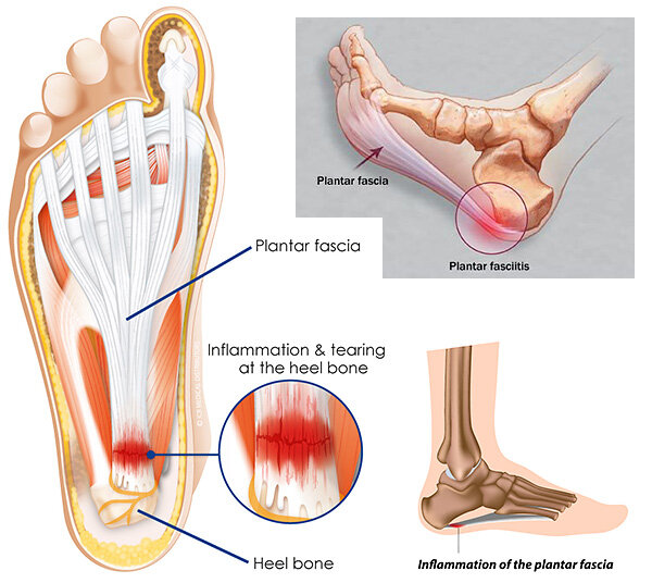 Say Goodbye to Foot Pain: PRP Treatment for Plantar Fasciitis
